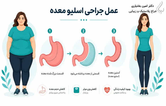 اسلیو معده چیست؟
