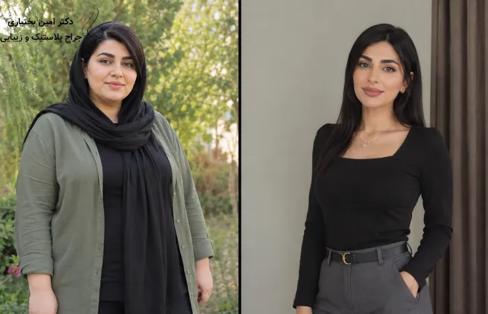 کاهش وزن بعد از اسلیو معده